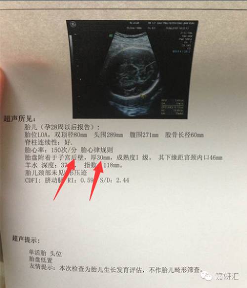 产科b超报告怎么看是否需要清宫,怎么看懂产检b超单