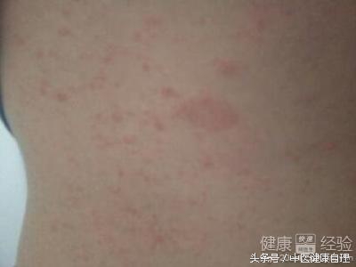 湿疹性皮炎中医辨证,小儿湿疹中医辨证