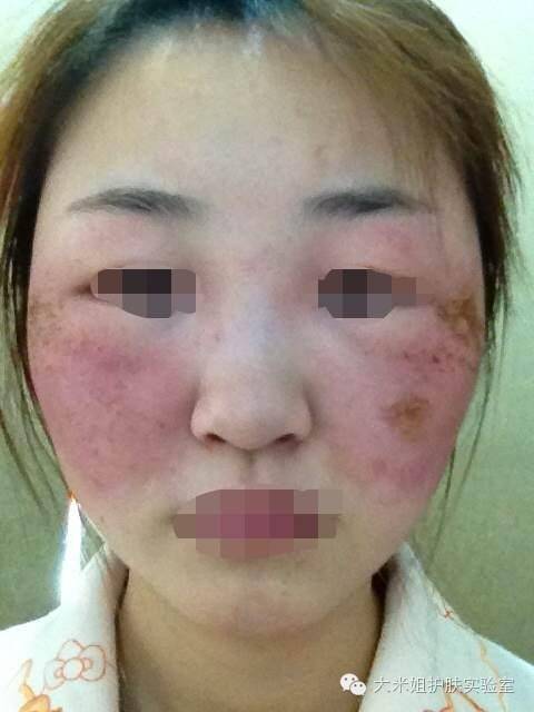 怎样才能避免得激素脸,激素脸的正确修复小窍门