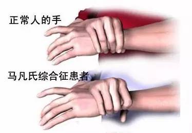 手长脚长似“蜘蛛人”，肇东一姐弟26岁“准时”发病，基因来自35岁去世的妈妈