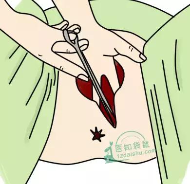 会阴侧切非做不可吗？几招预防方法教给您