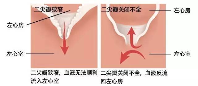 干货丨“心脏阀门”二尖瓣出故障了怎么办？