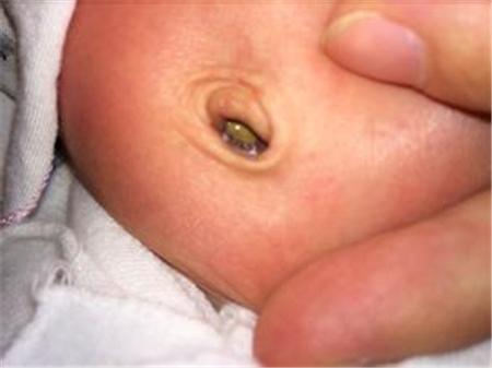 孕妇肚脐黑色污垢怎么清理,新生儿肚脐每天都要清理吗