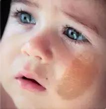 白色胎记的图片,胎记知多少基础篇