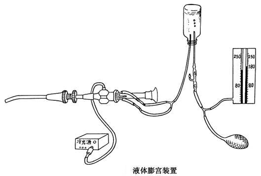 宫腔镜手术需要清肠吗,宫腔镜手术需要用水扩大宫腔吗