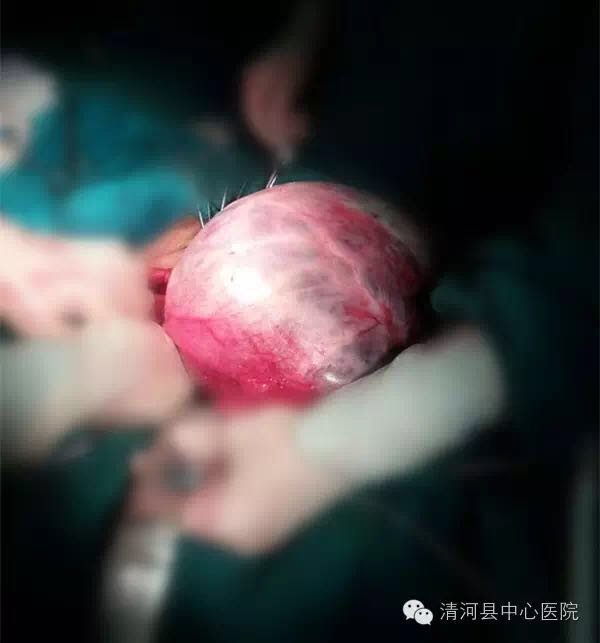 六旬老太怀孕自称腹部隆起,六旬老太腹部隆起将临盆全集