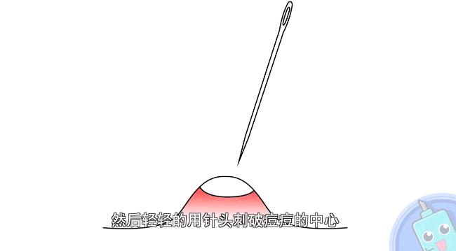 挤痘怎样才能不留痘坑,挤痘痘不留痘印的小妙招