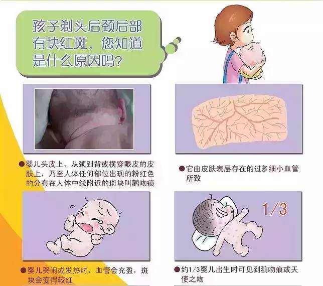 宝宝身上有哪些胎记,有胎记的小孩儿是不是天使