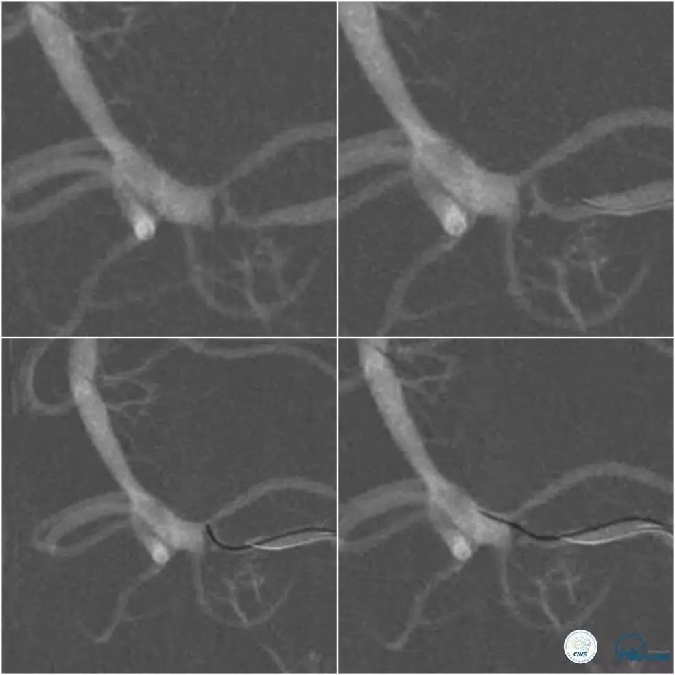 天坛周记|左椎V4段-基底动脉交界区狭窄的支架治疗