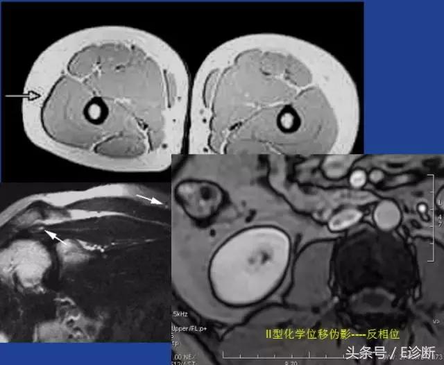 磁共振伪影及解决方案,e系列诊断
