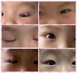 宝宝眼皮长痘痘是怎么回事,上下眼皮都长了豆豆怎么办