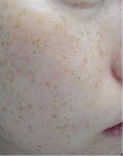 美白祛斑祛痘抗皱五件套,祛斑祛痘美白抗皱