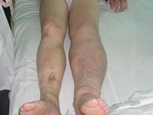 “*品毒**”引起的皮肤病变，触目惊心！