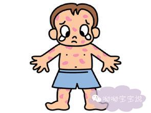孩子生疹子有什么症状怎么治疗,八个月宝宝发烧是起疹子症状吗