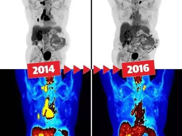 不用化疗就能治愈肺癌，澳洲医学界再传好消息！