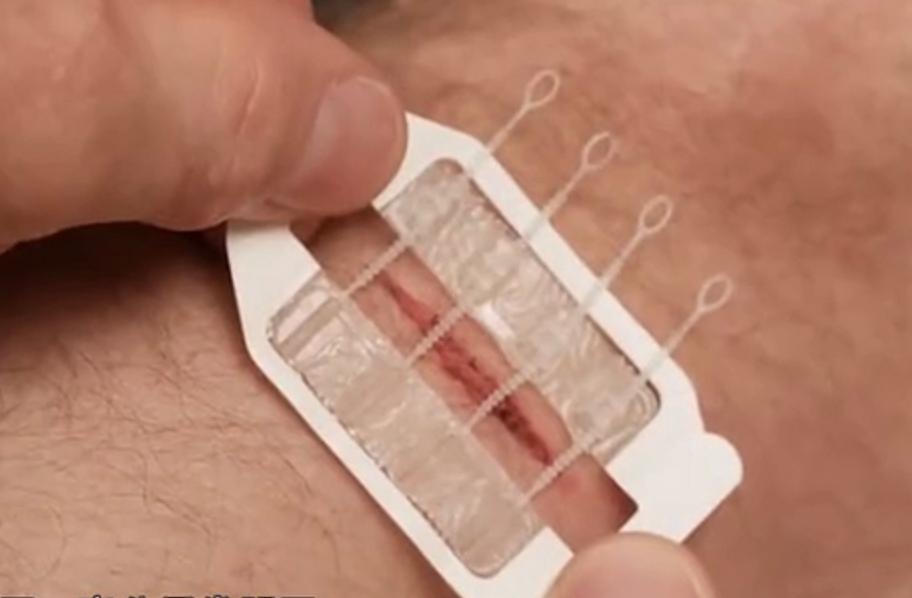 受伤后如何护理才能避免留疤,额头受伤怎么防止留疤