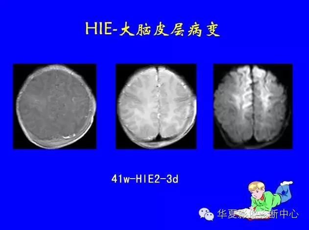 新生儿颅脑mri,新生儿颅脑mr报告模板