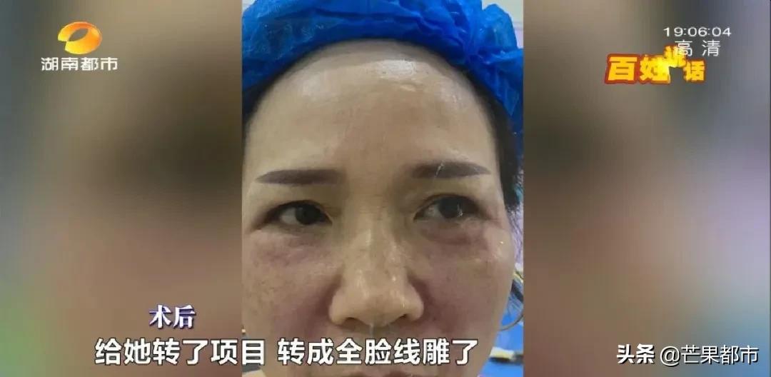 医生推荐去除法令纹,长沙法令纹除皱