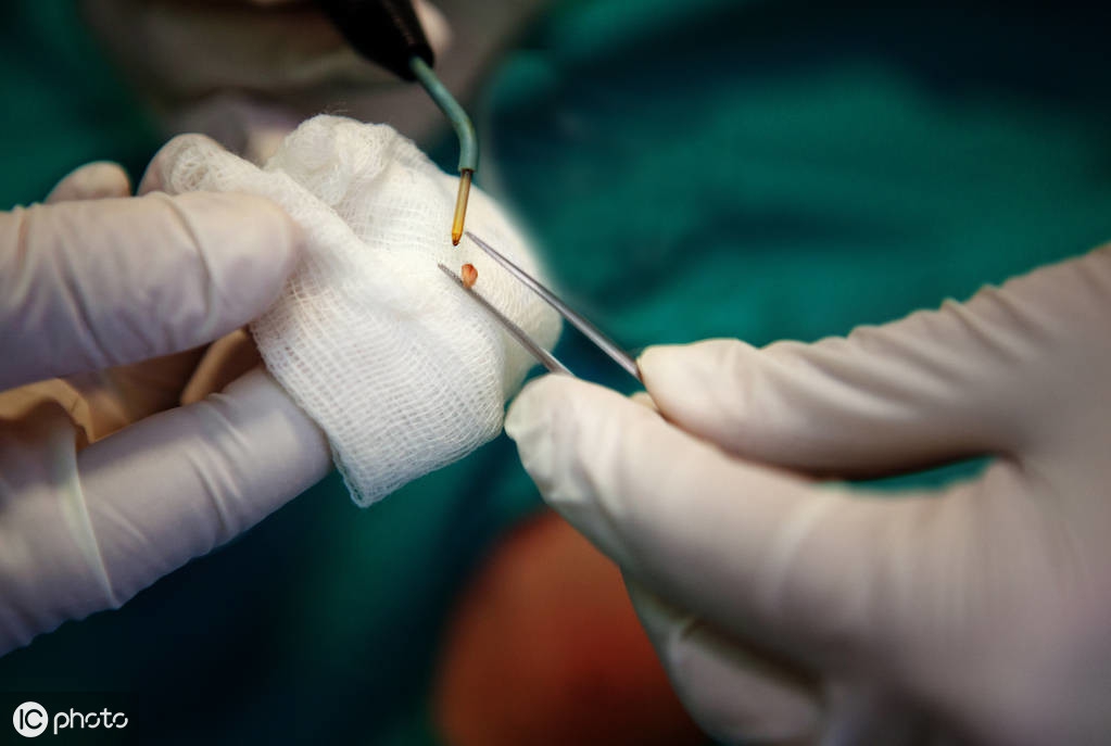 治疗尖锐湿疣排毒有哪些方法,尖锐性湿疣治好案例