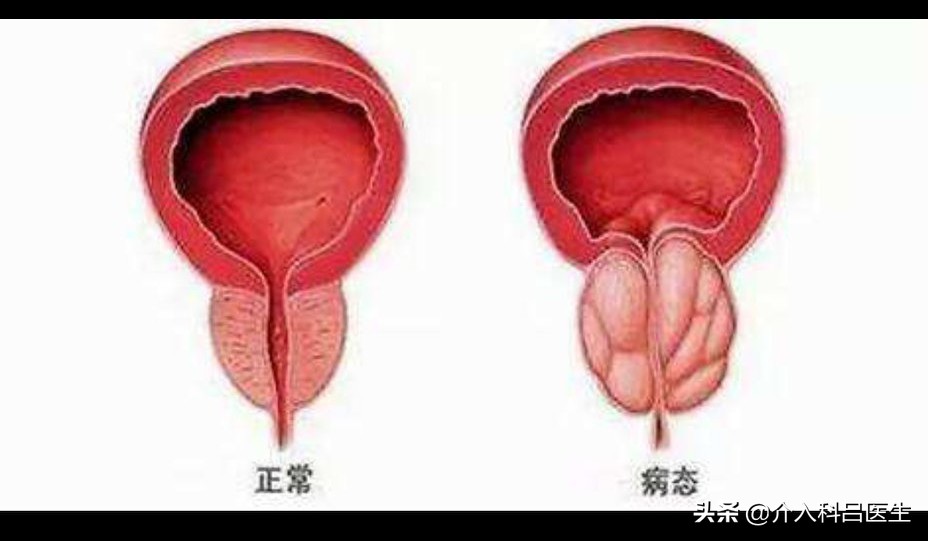 前列腺增生尿频夜尿多吃中成药,前列腺增生尿频尿急漏尿如何治疗