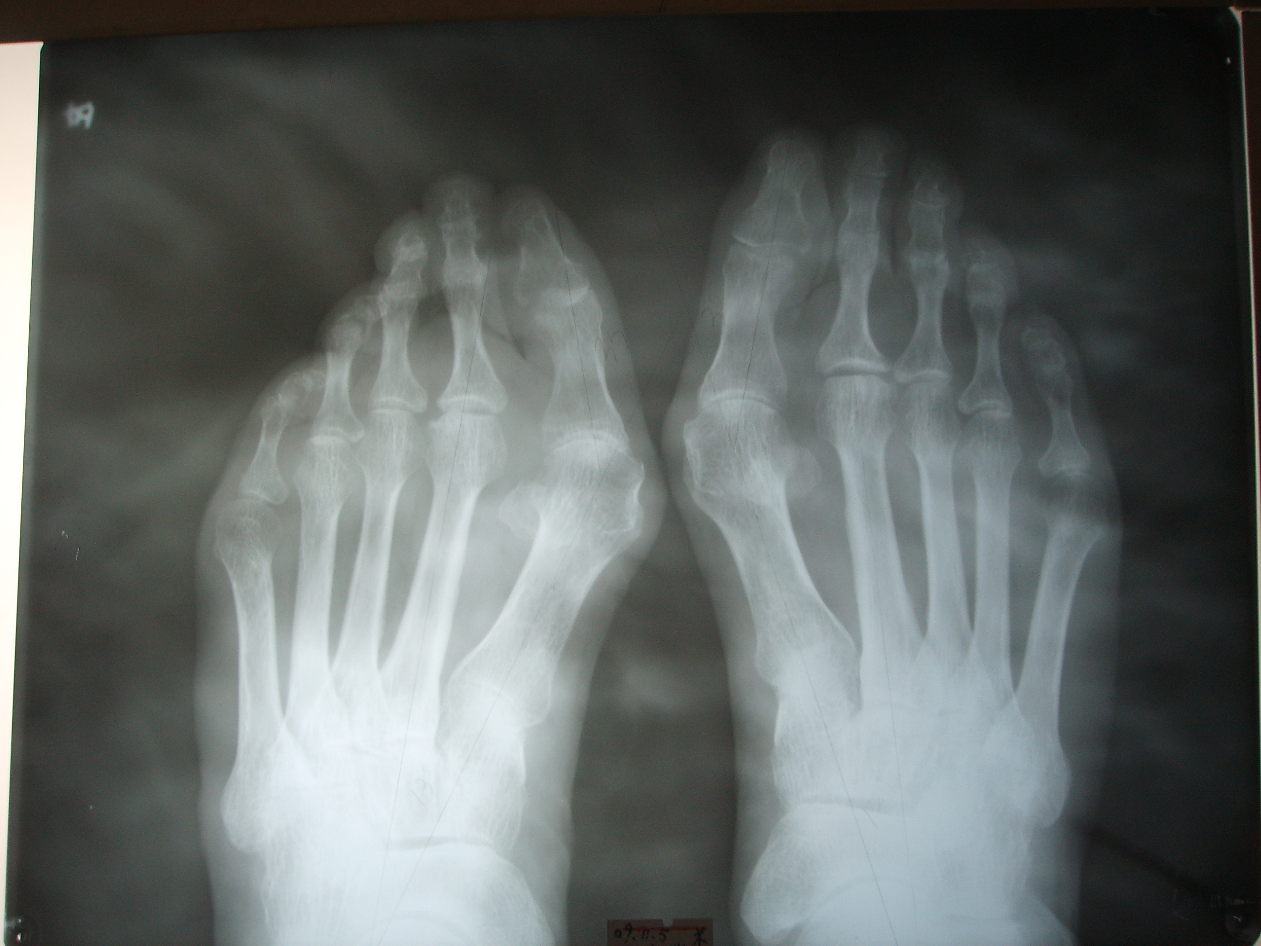 广东河源58岁大姐大脚骨，前足足横弓塌陷，脚很宽怎么办