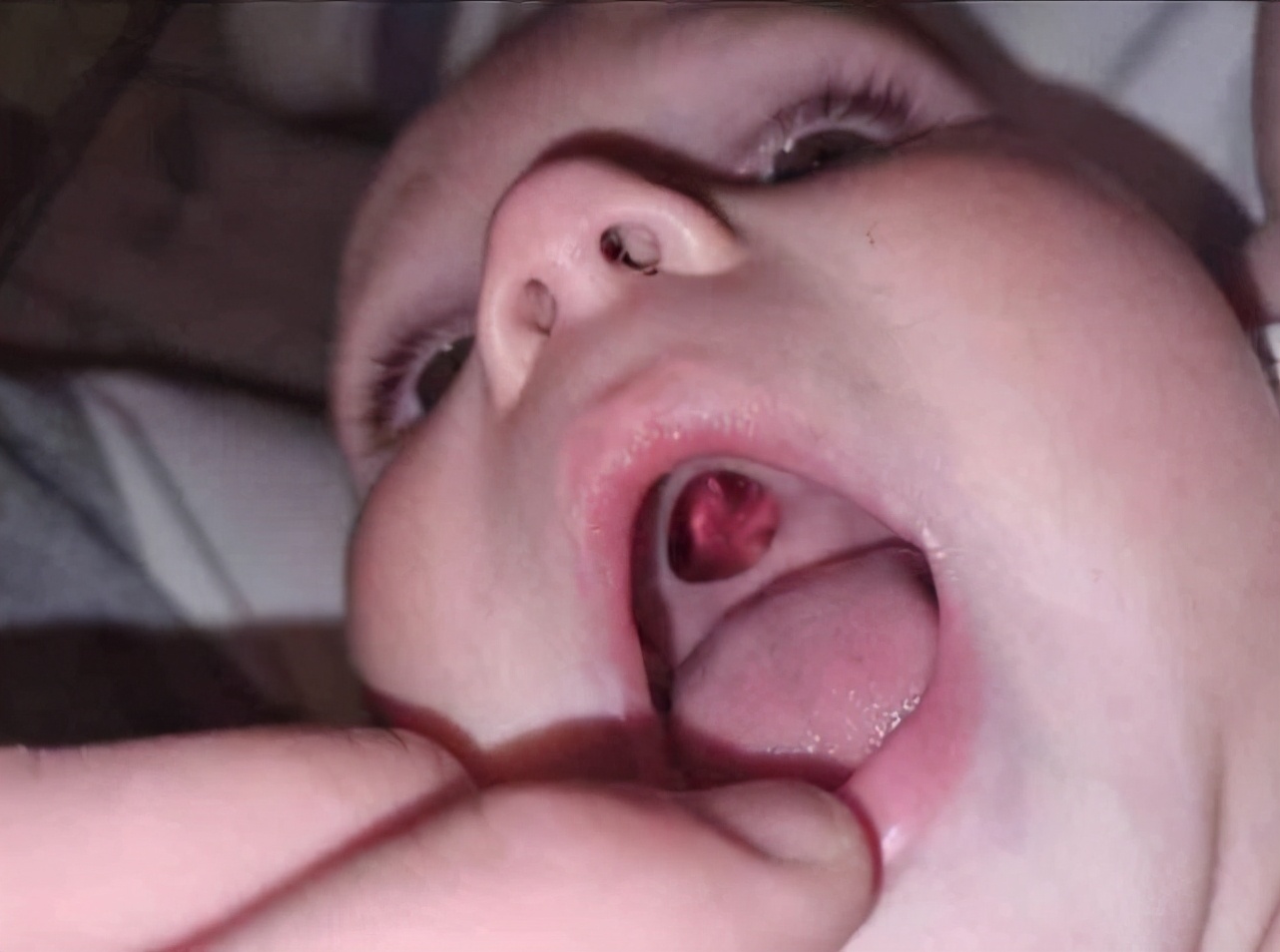 宝宝嘴巴内壁上有个小洞,宝宝嘴里有个塑料袋一样的东西