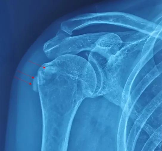 肩钙化性肌腱炎术后疼痛,肩钙化性肌腱炎