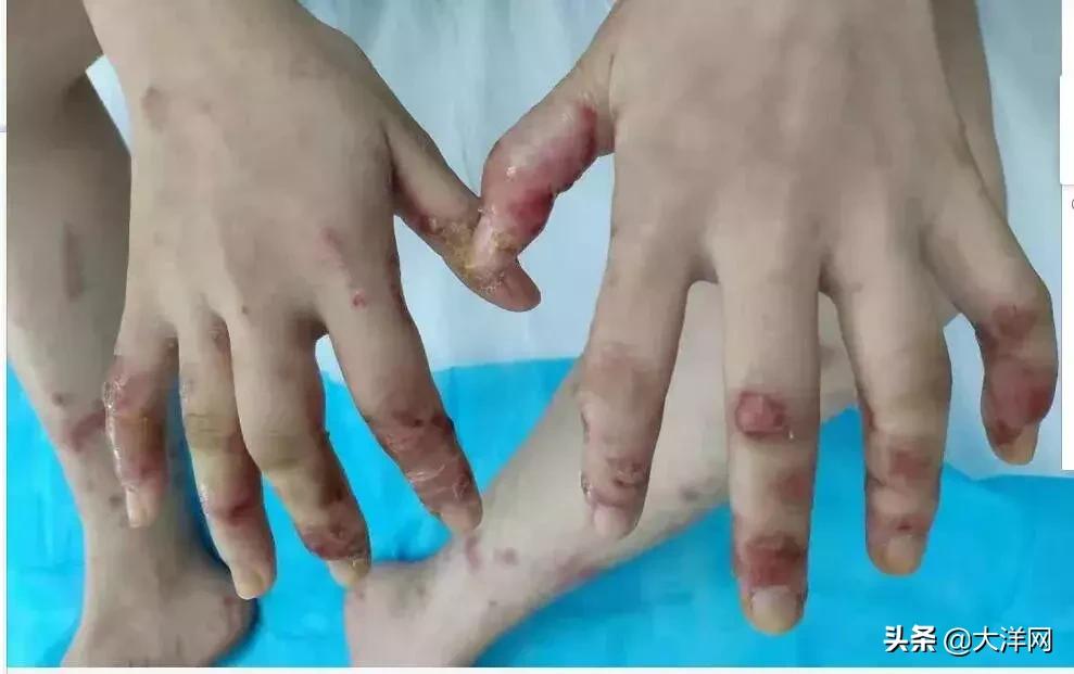 19岁女孩天天吃鱼，竟导致手脚“满目疮痍”！医生一句话说出真相