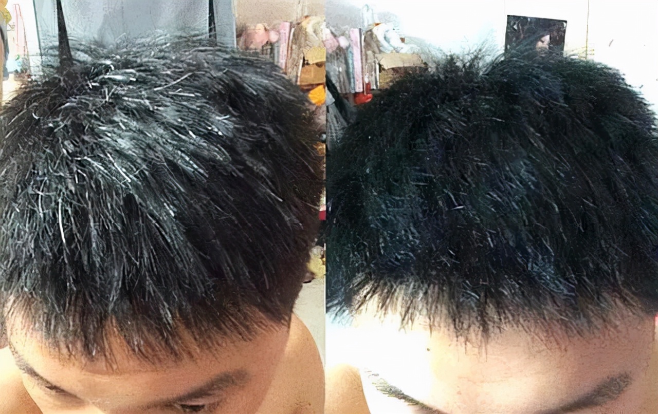 白发的引起原因和白发调理方法,发量稀少如何调养