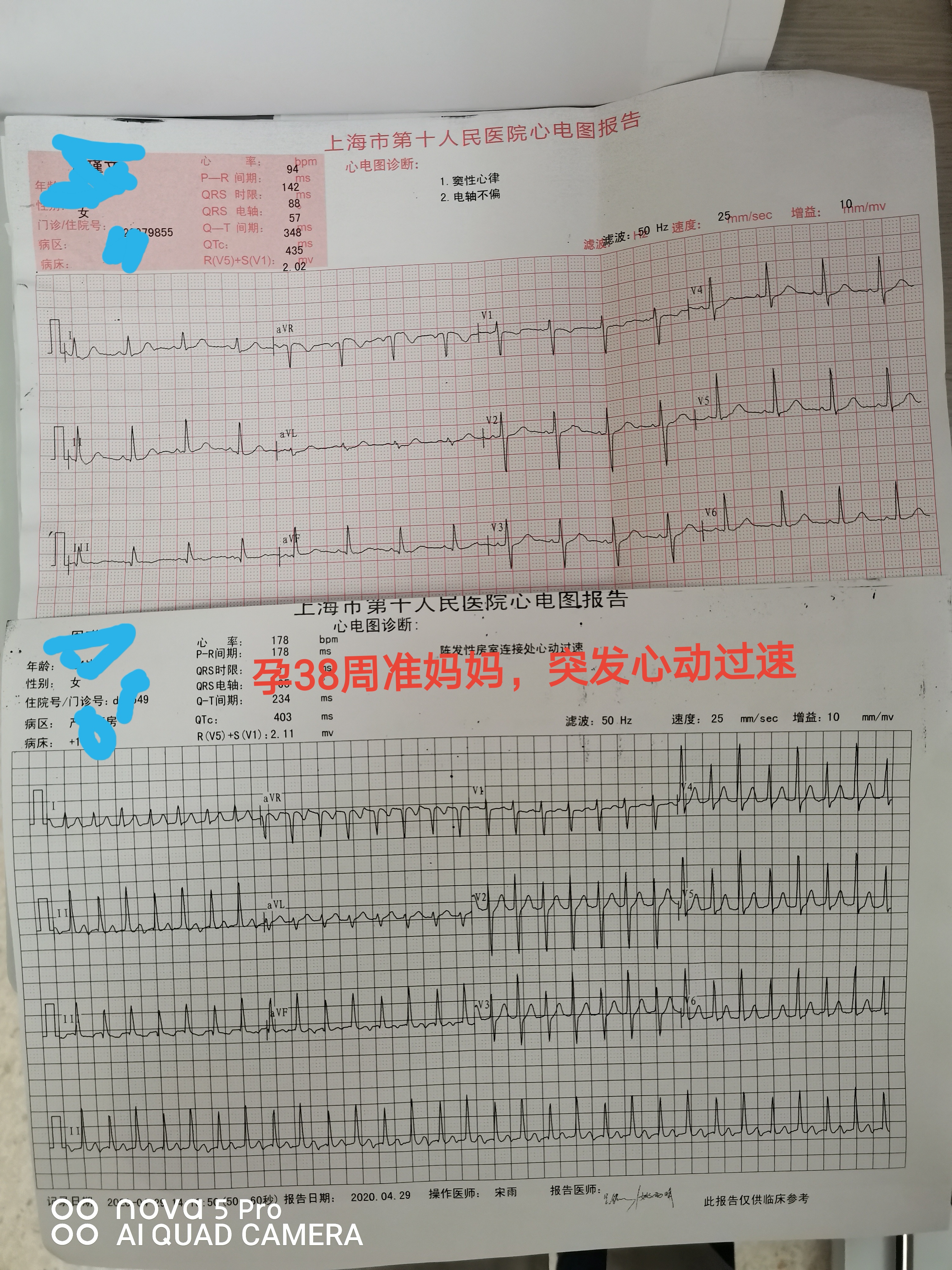 孕妇25周心动过速怎么办,孕28周孕妈心动过速