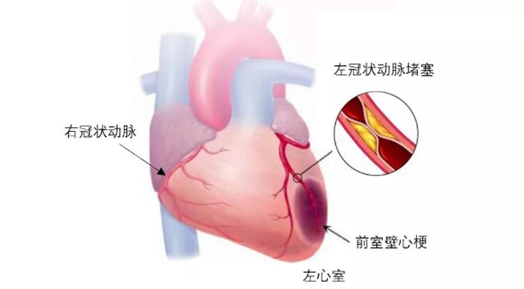 冠心病室性早搏治疗药物,冠心病常用的药物治疗有哪些