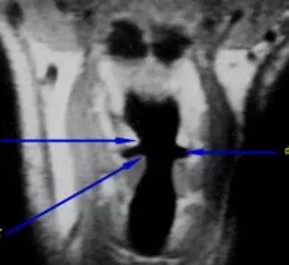 喉部病变做核磁还是ct,耳鼻喉科常见病影像诊断