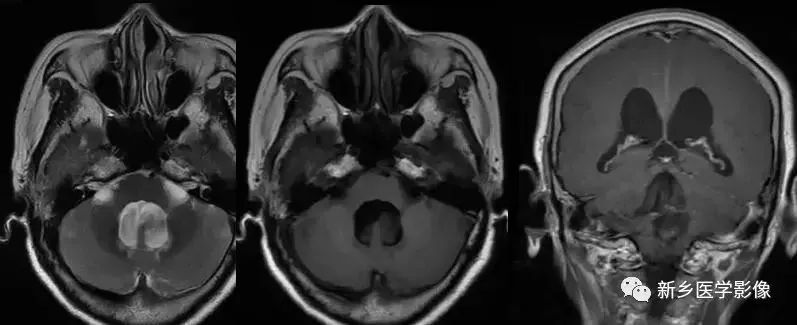 影像学脑室扩大,脑室显大怎么理解