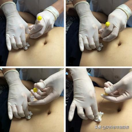 如何学针灸减肥知识点总结,健康大讲堂针灸减肥