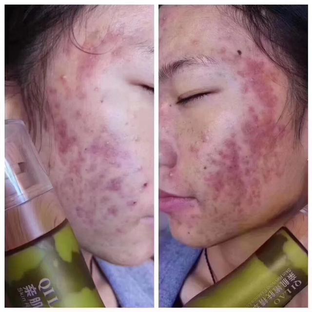 七老真的能修复激素脸吗,七老真的能修复好激素脸吗