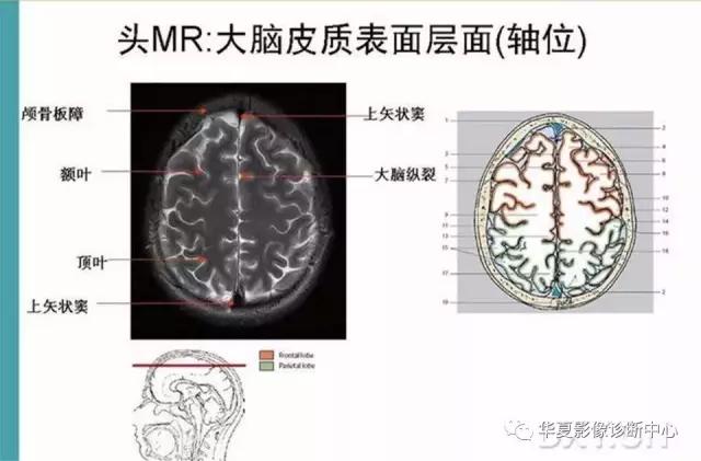 电子版头颅ct与mri断层解剖,头颅mri血管解剖与分段详解
