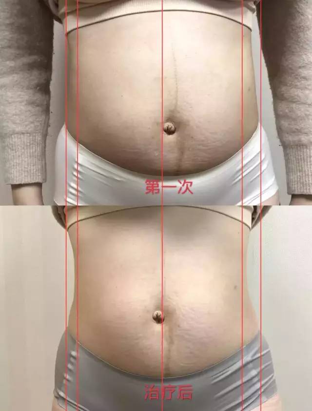 腹直肌分离三年康复的妈妈,腹直肌分离的宝妈们需要注意什么