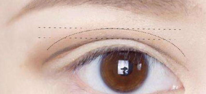 开眼角的魅力有多强,开眼角让你美丽蜕变