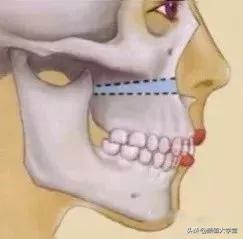 凸嘴有什么方法改善,形成嘴凸的原因