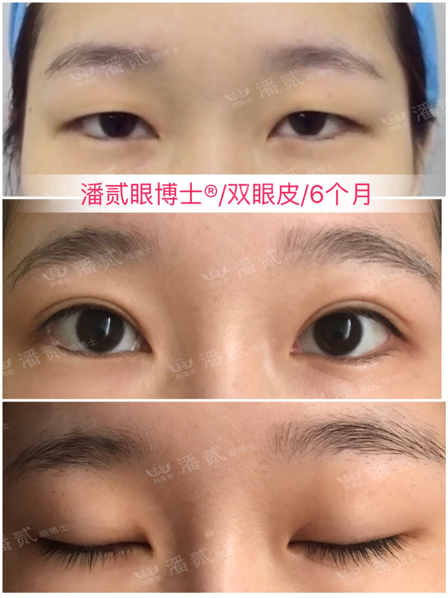 双眼皮眼尾割长了而且上扬怎么办,眼睛眼尾下垂做什么样双眼皮