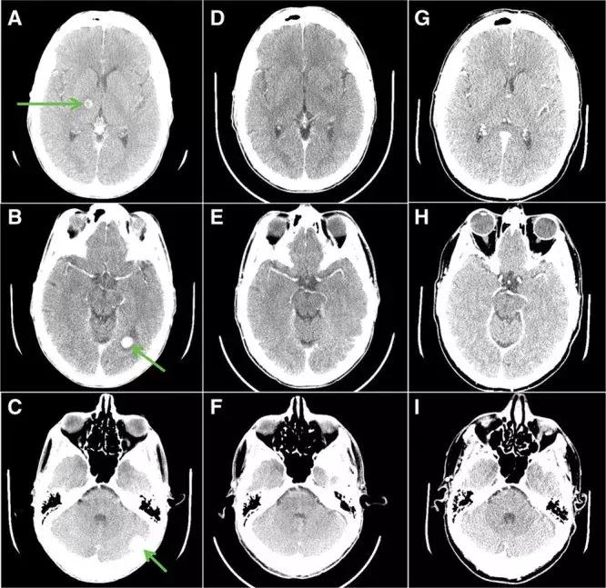 最新国外抗癌药,世界公认最好的抗癌药