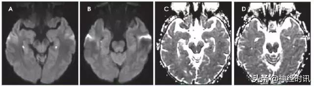 脑卒中病历诊断书图片,脑卒中影像判断技巧图解电子版