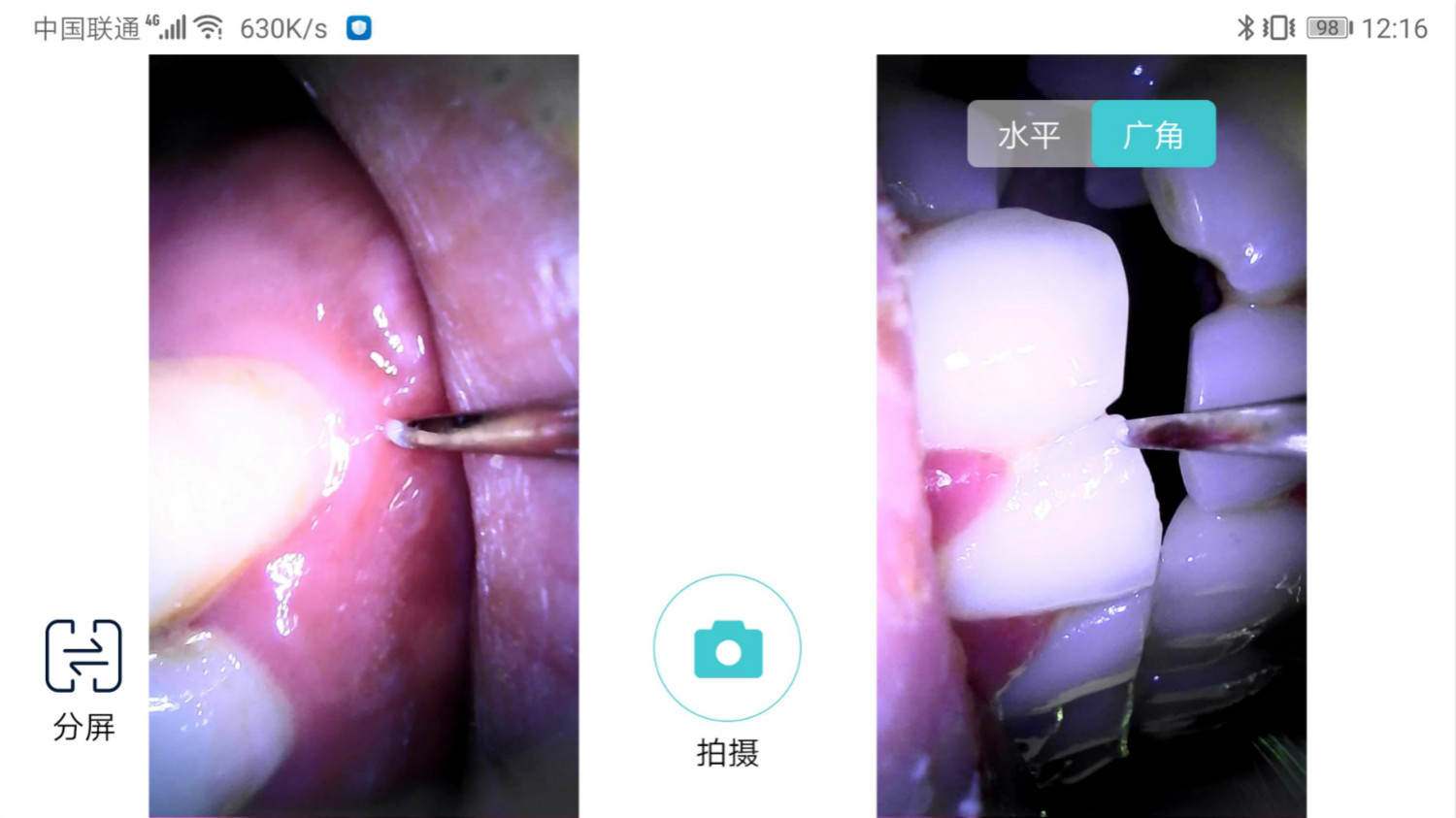 电动牙刷做不到的它可以！素诺智能可视超声波洁牙仪T11Pro测评