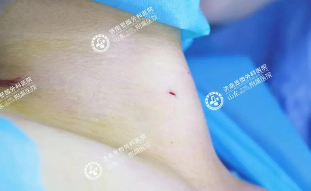 甲状腺结节该不该手术这篇说全了,甲状腺结节到底开刀好还是微创好