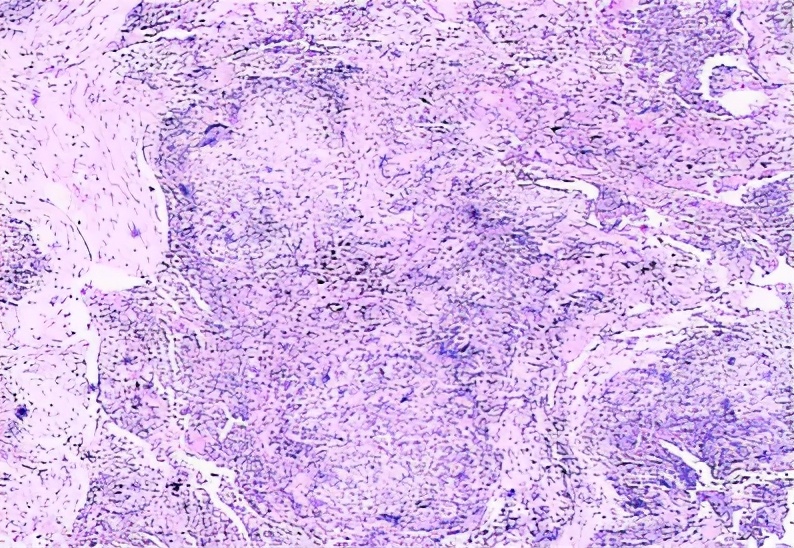 养鸽子造成皮肤真菌感染,养鸽子会得肺炎吗