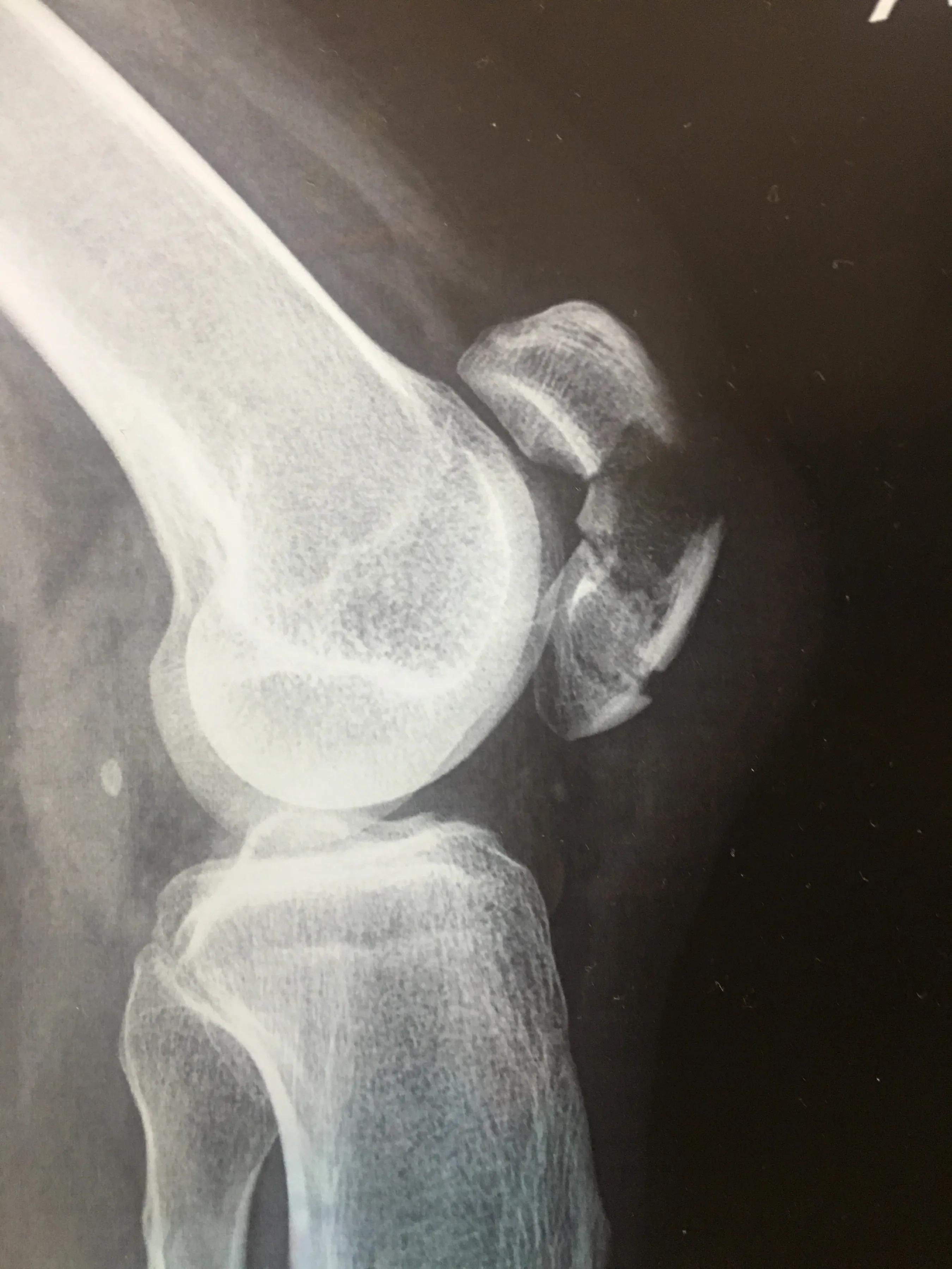 髌骨骨折取内固定费用多少,髌骨骨折保守治疗后的康复训练