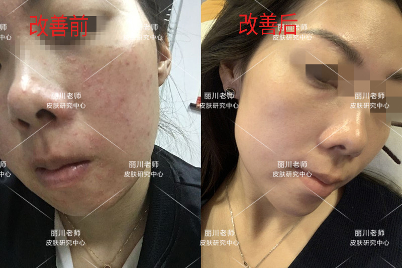 兰亭护肤品能治疗激素脸吗,兰亭护肤品有适合油皮长痘用的吗