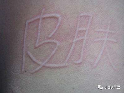 怎样快速缓解荨麻疹的瘙痒症状,慢性荨麻疹和荨麻疹有什么区别