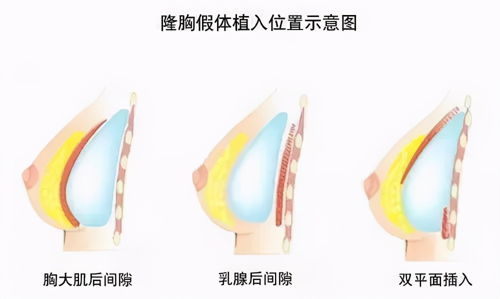 隆过胸的妈妈,母乳里真的有毒吗?