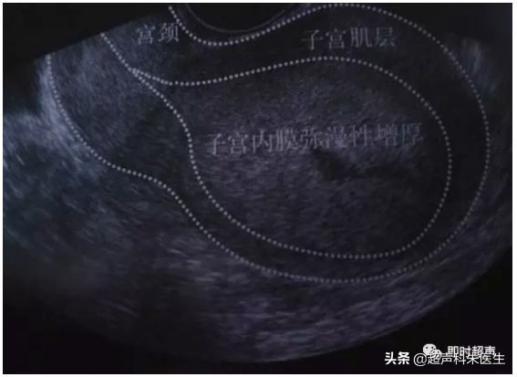 妇科超声的标准超声图,妇科超声图解